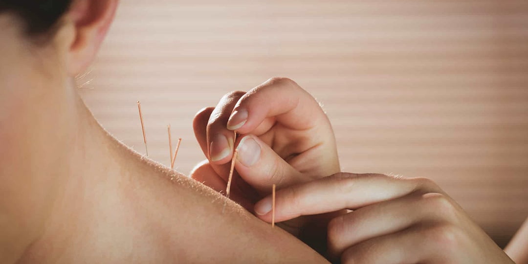 acupuncture acupuncture