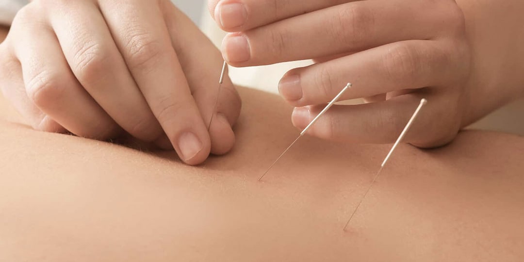 dry needling dry needling